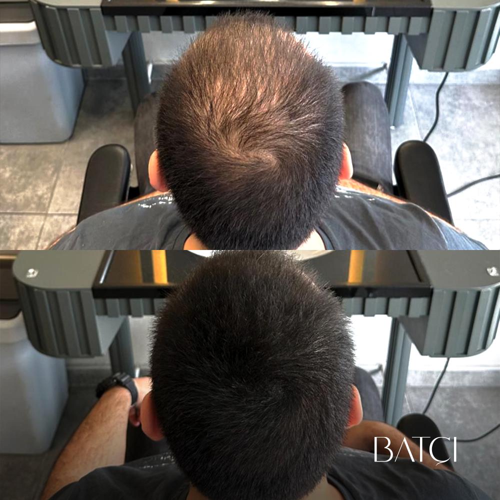 Tinte Profesional Especial Cubre Calvicie y Canas