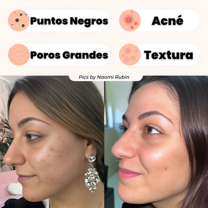 Kit Limpiador de Espinillas y Puntos Negros con Succionador Profesional